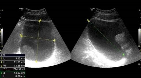 známky prostatitidy na ultrazvuku