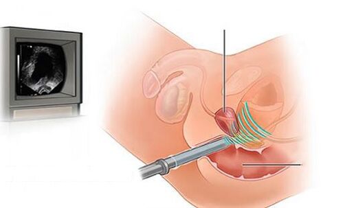 ultrazvuk prostaty