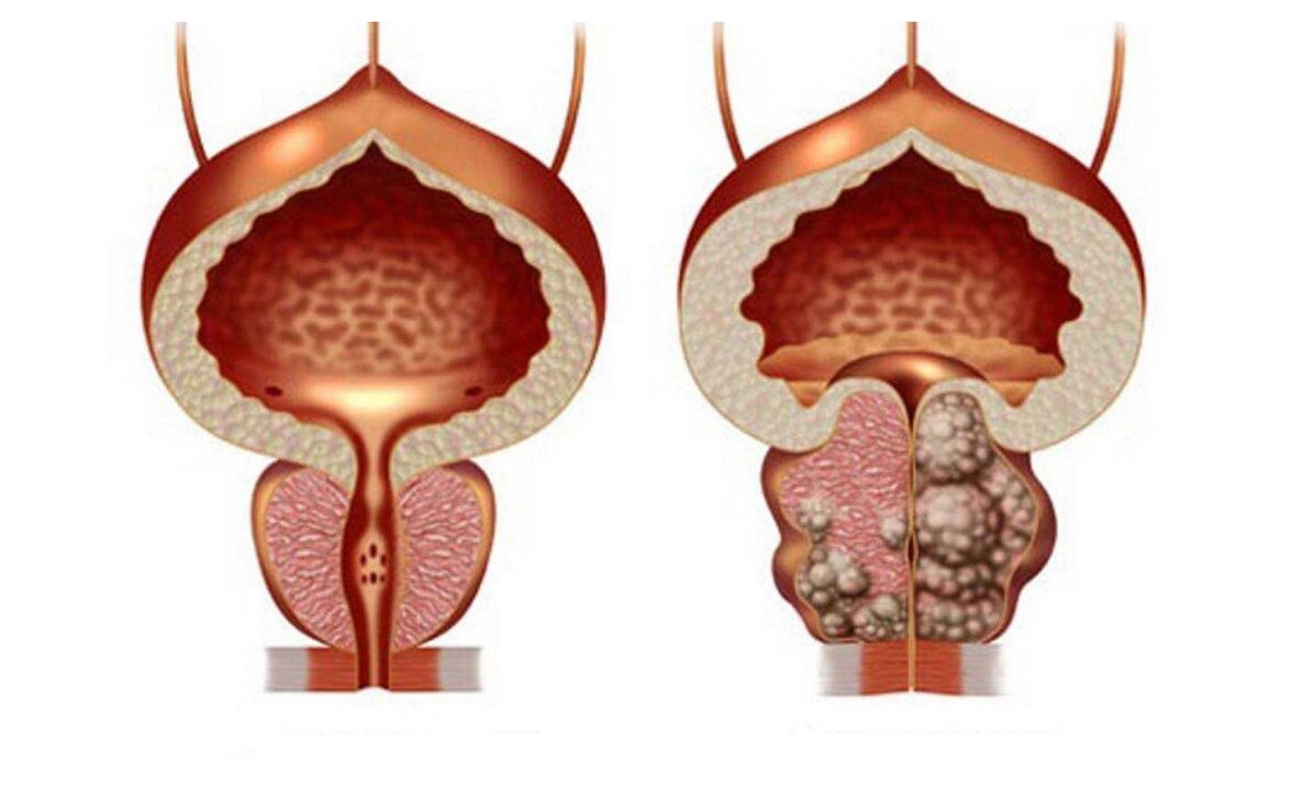 adenom prostaty